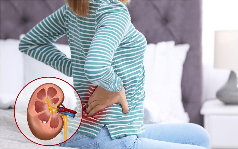 Kidney Stones: A Complete Breakdown of Causes and Symptoms
